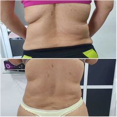 Hidrolipoclasia