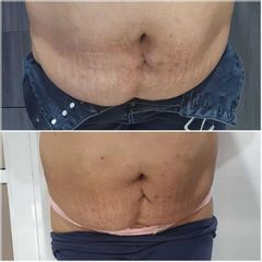 Hidrolipoclasia