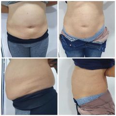 Antes y después de Hidrolipoclasia