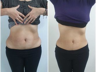 Lipólisis antes y después - 809002