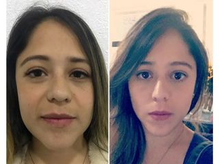 Antes y después de Bichectomia y relleno de surcos nasogenianos