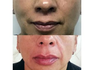 Antes y después de Aumento de labios