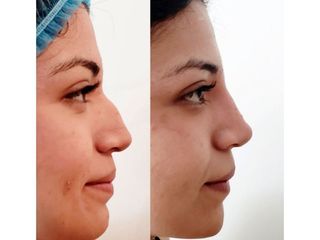 Antes y después de Rinoplastia