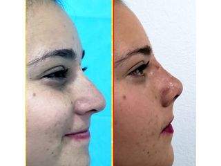 Antes y después de Rinoplastia