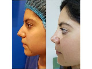 Antes y después de Rinoplastia