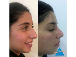 Antes y después de Rinoplastia