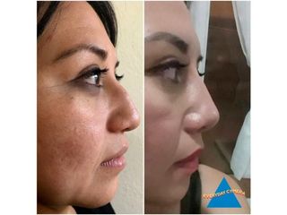 Antes y después de Rinoplastia