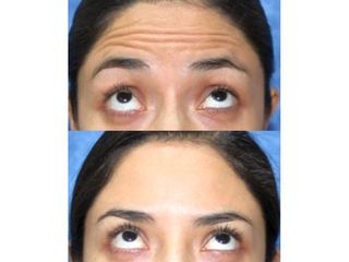 Antes y después de Rejuvenecimiento facial con bótox