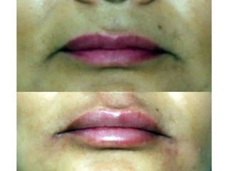 Antes y después de relleno de labios