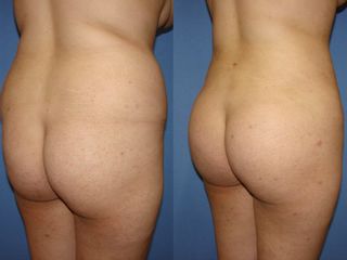 Antes y después de una lipoescultura con lipo inyección glútea