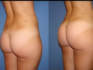 Antes y después de una lipo inyección glútea