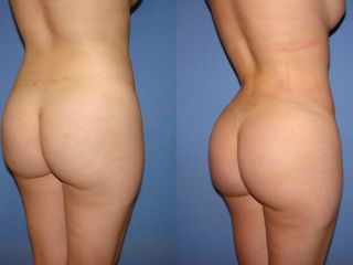 Antes y después de una lipo inyección glútea
