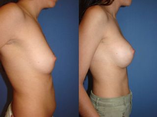 Antes y después de un aumento de busto 