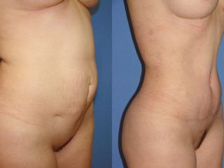 Antes y después de una abdominoplastia 