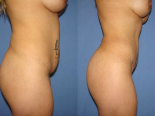 Antes y después de una abdominoplastia o dermolipectomia 