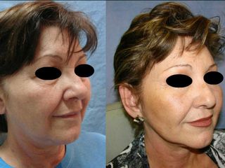 Antes y después de una blefaroplastia