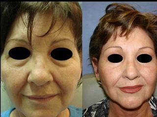 Antes y después de una blefaroplastia