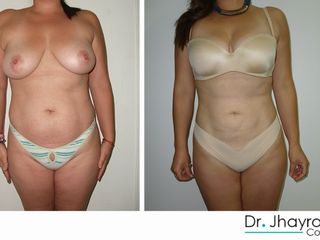 Antes y después Lipoescultura