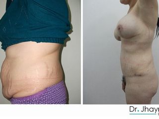 Antes y después de Abdominoplastia