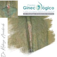 Labioplastia 