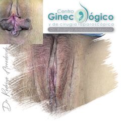 Labioplastia - Centro Ginecológico y de Cirugía laparoscópica
