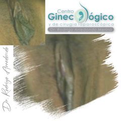 Labioplastia - Centro Ginecológico y de Cirugía laparoscópica