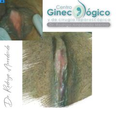 Labioplastia - Centro Ginecológico y de Cirugía laparoscópica