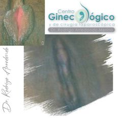 Labioplastia - Centro Ginecológico y de Cirugía laparoscópica