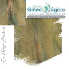 Labioplastia - Centro Ginecológico y de Cirugía laparoscópica