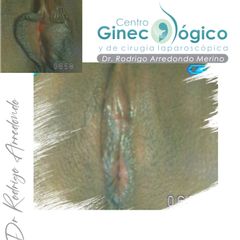 Labioplastia - Centro Ginecológico y de Cirugía laparoscópica