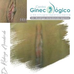 Labioplastia - Centro Ginecológico y de Cirugía laparoscópica