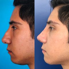 Antes y después de Rinoplastía. Corrección de Fractura Nasal 