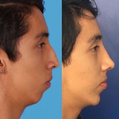 Antes y después de Rinoplastía Estética y Funcional + Implante de Mentón