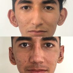 Antes y después de Otoplastía Bilateral. Corrección de orejas prominentes.