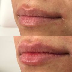 Antes y después de Aumento de labios con Ácido Hialurónico.