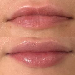 Antes y después de Aumento de Labios con Ácido Hialurónico