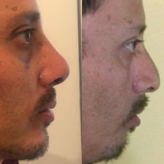 Antes y después de Rinoplastía Estética + Implante de Mentón 