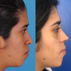 Antes y después de Rinoplastía y mentoplastía a 1 mes de cirugía 