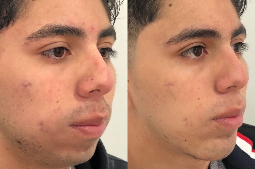 Mentoplastia antes y después - 648109