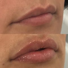 Antes y después de Aumento de Labios con Ácido Hialurónico 