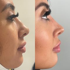 Antes y después de Rinoplastia