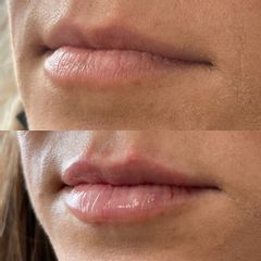 Aumento de labios con ácido hialurónico - Dra. Liz Parra