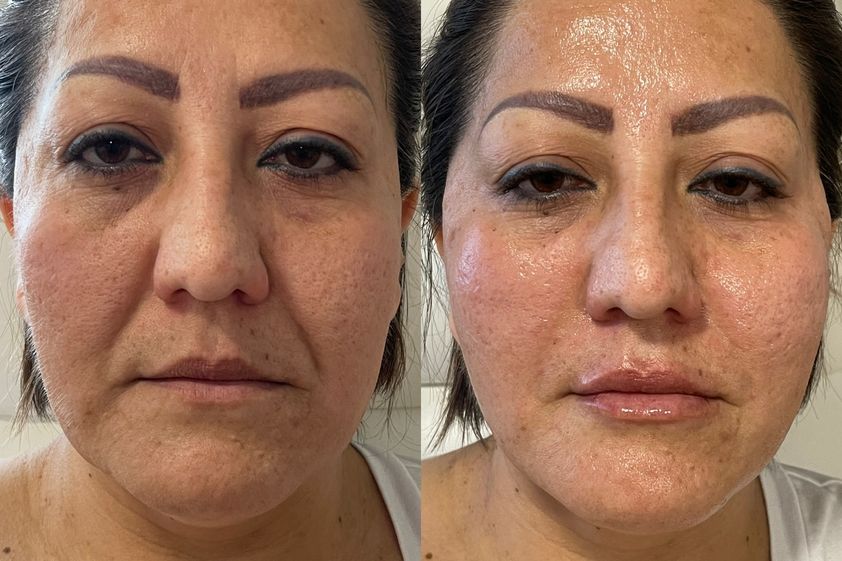 Hilos tensores antes y después - 821345