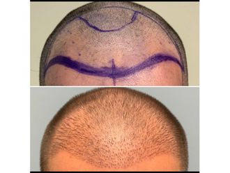 Trasplante de cabello - 639040