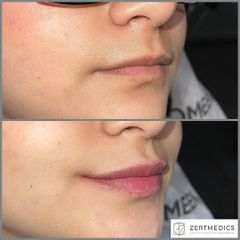 Aumento de Labios Zertmedics 