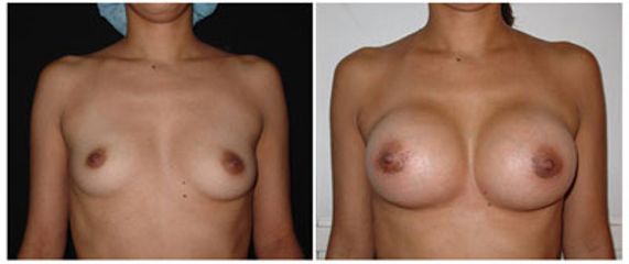 Antes y después de Aumento de busto