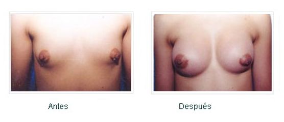 Antes y después de Aumento de busto