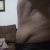 No me gustó el resultado de la lipoescultura