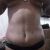 No me gustó el resultado de la lipoescultura