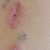 Eliminación de tatuaje con cirugía